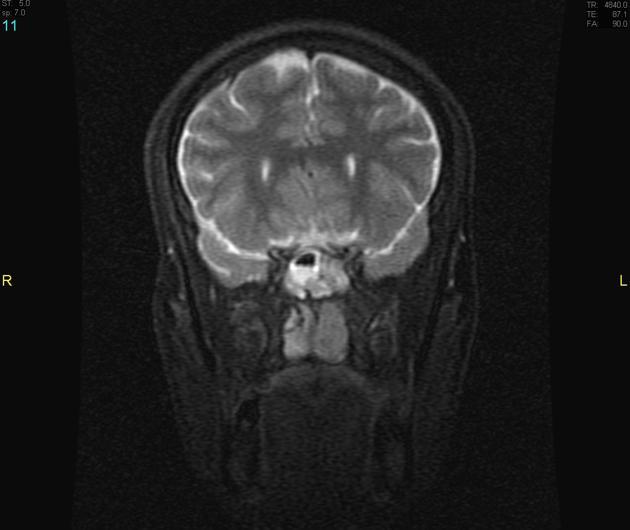 MRI showing T2 image of esthesioneuroblastoma[2]