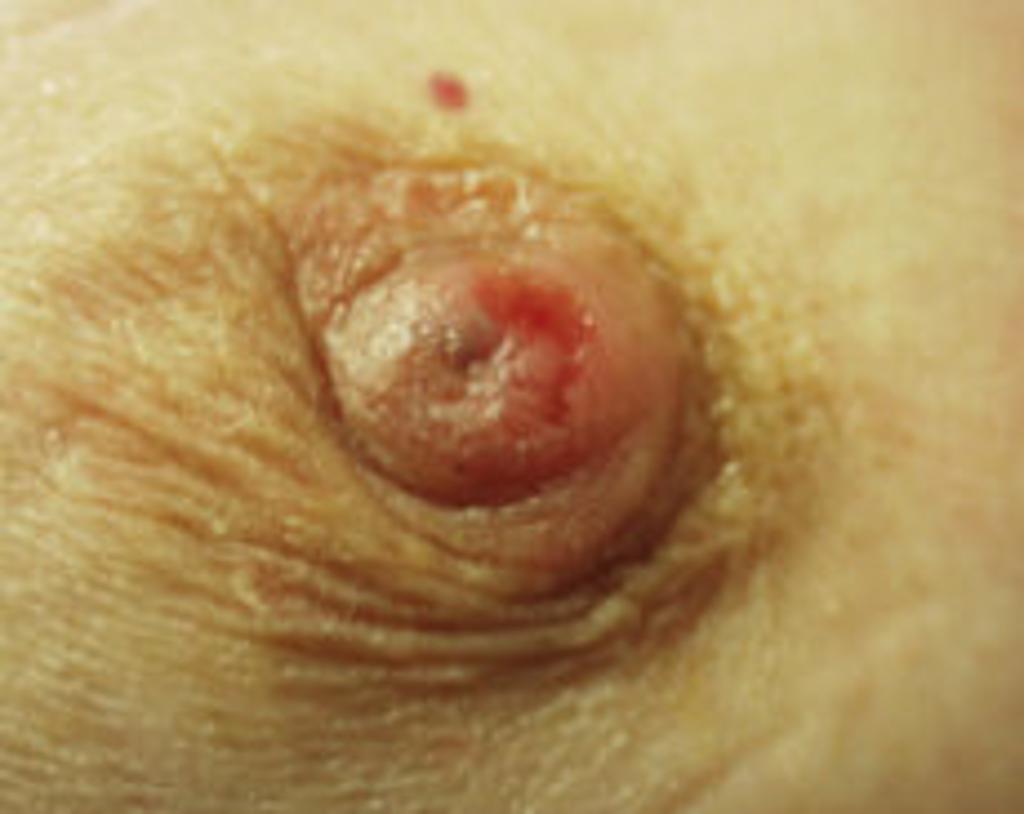 File:Paget disease of the breast.jpg