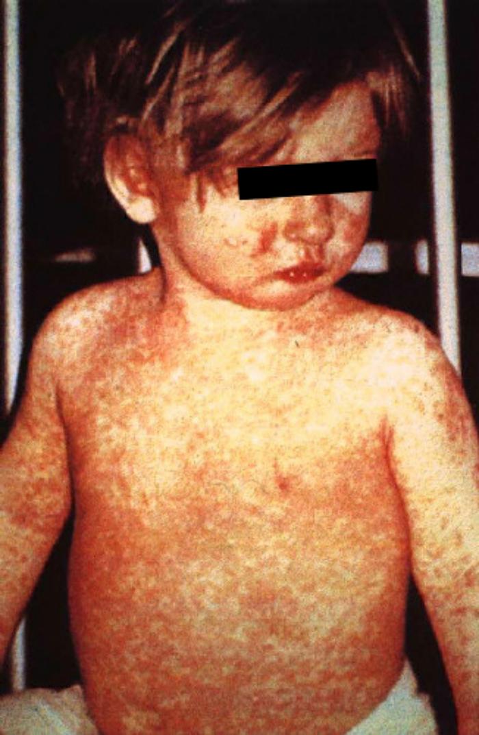 Image showing characteristic day 4 appearance of measles rash.