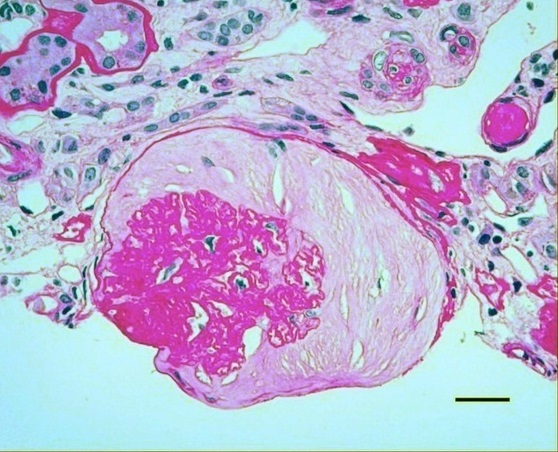 File:Histopathology of hypertensive glomerular lesion of hypertensive nephropathy.jpg