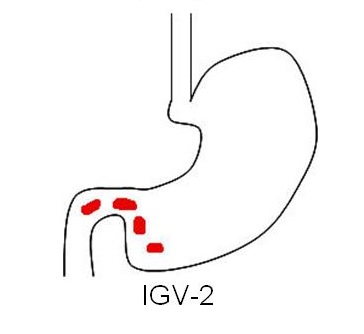 Isolated gastric varices type 2, via Wikipedia.org
