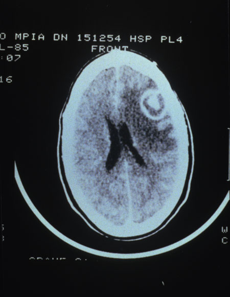 File:Toxoplasma gondii CT scan showing cerebral abscess.jpg
