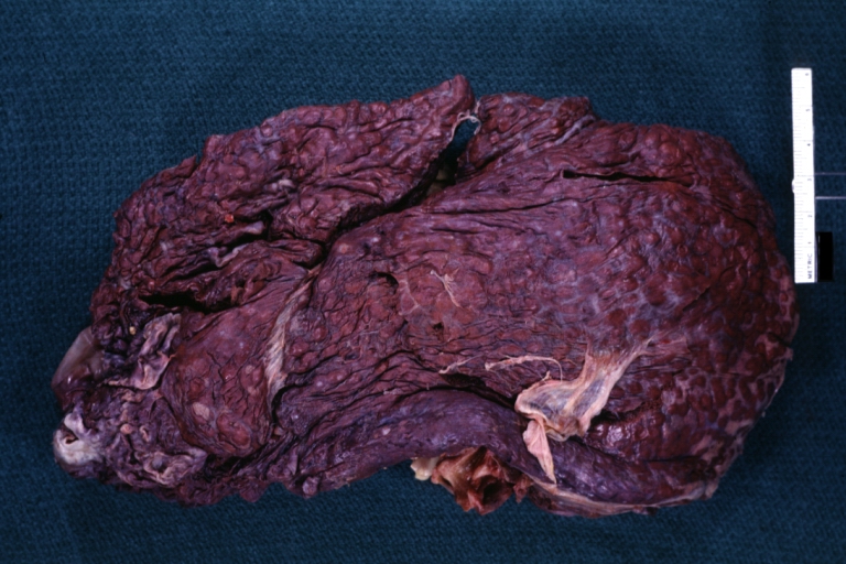 Lung: Hematite: Gross, natural color, external view of "pulmonary cirrhosis" with typical hematite color
