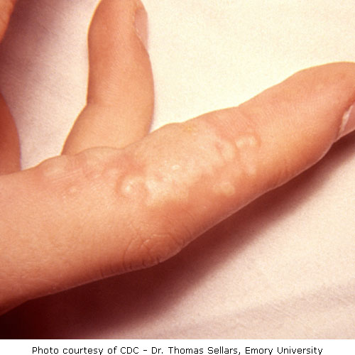 Vesiculobullous lesions of the fingers of a patient with Herpetic Whitlow