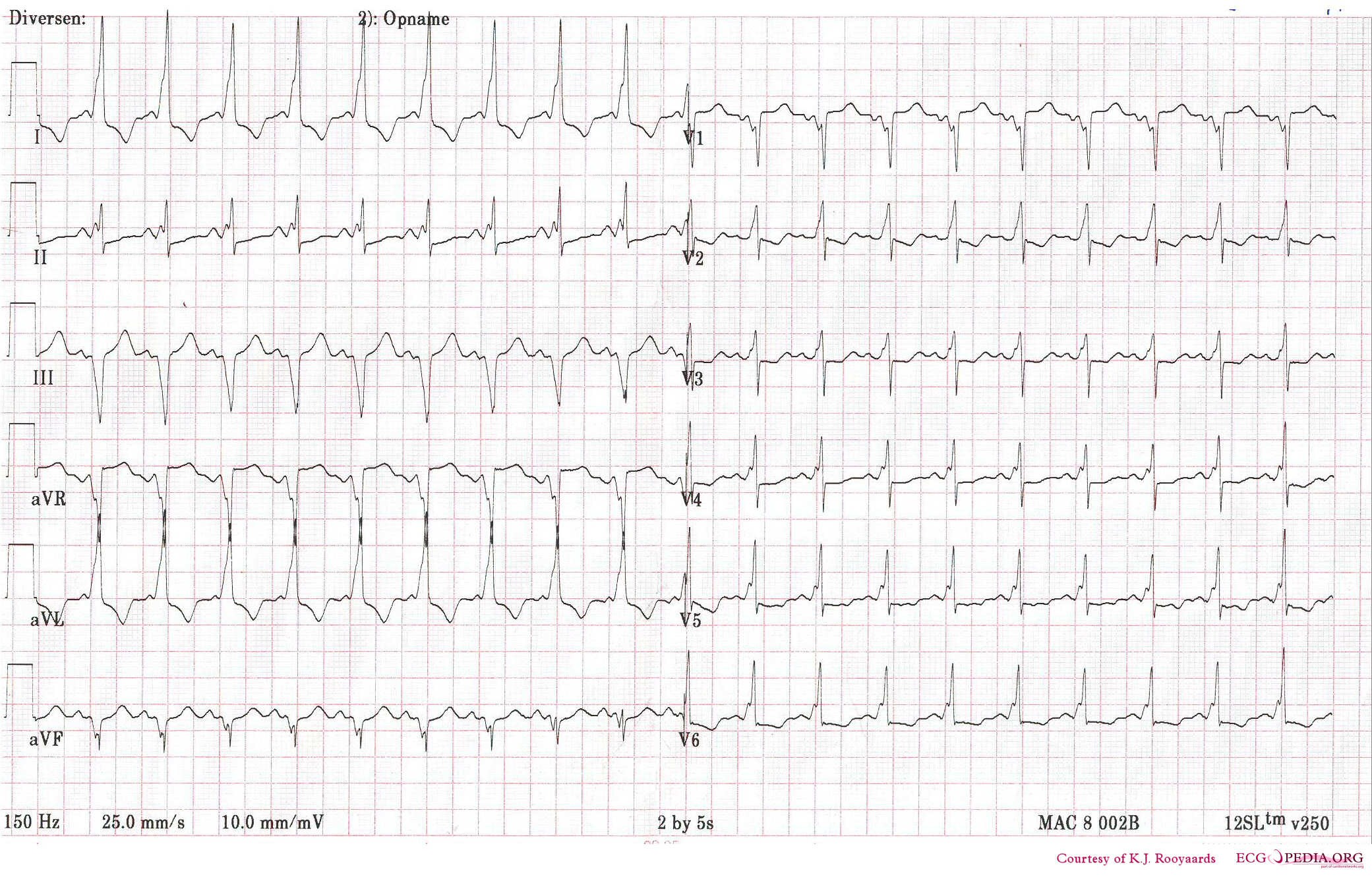 File:WPW with sinus tachycardia mimicking VT.jpg