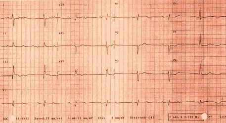 Two-to-one AV block can represent benign block within the AV node or disease of the His-Purkinje system. Certain electrocardiographic features and maneuvers can help in distinguishing where the location of block exists. A long PR interval with a narrow QRS suggests an intranodal block. A short PR interval with intraventricular conduction delay or bundle branch block suggests disease below the node. Responses to atropine, exercise and carotid sinus massage can be helpful in diagnosis. Atropine will improve AV nodal conduction but will worsen block within diseased His-Purkinje fibers. Exercise has a similar effect, improving conduction in cases where block exists only in the node, but worsening when block is subnodal. Alternatively, Carotid Sinus Massage will slow conduction when block occurs in the AV node, but will improve conduction in diseased His-Purkinje tissue by allowing for refractoriness to recover