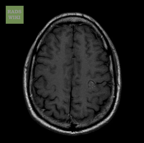MRI: Cavernous malformation