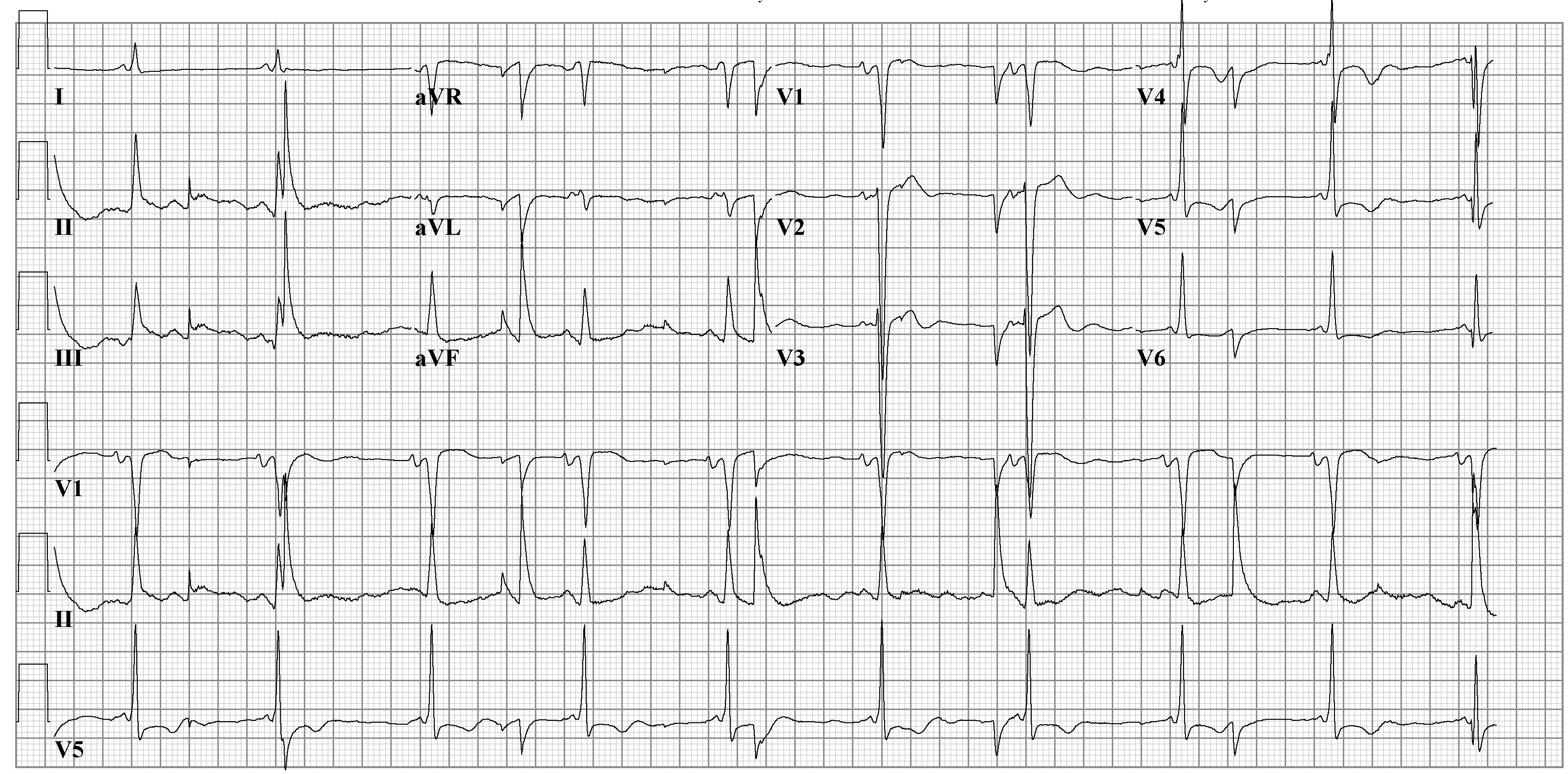 Another example of an artifact caused by an electrical appliance. The patients rhythm is regular. This strip shows 10 QRS complexes.