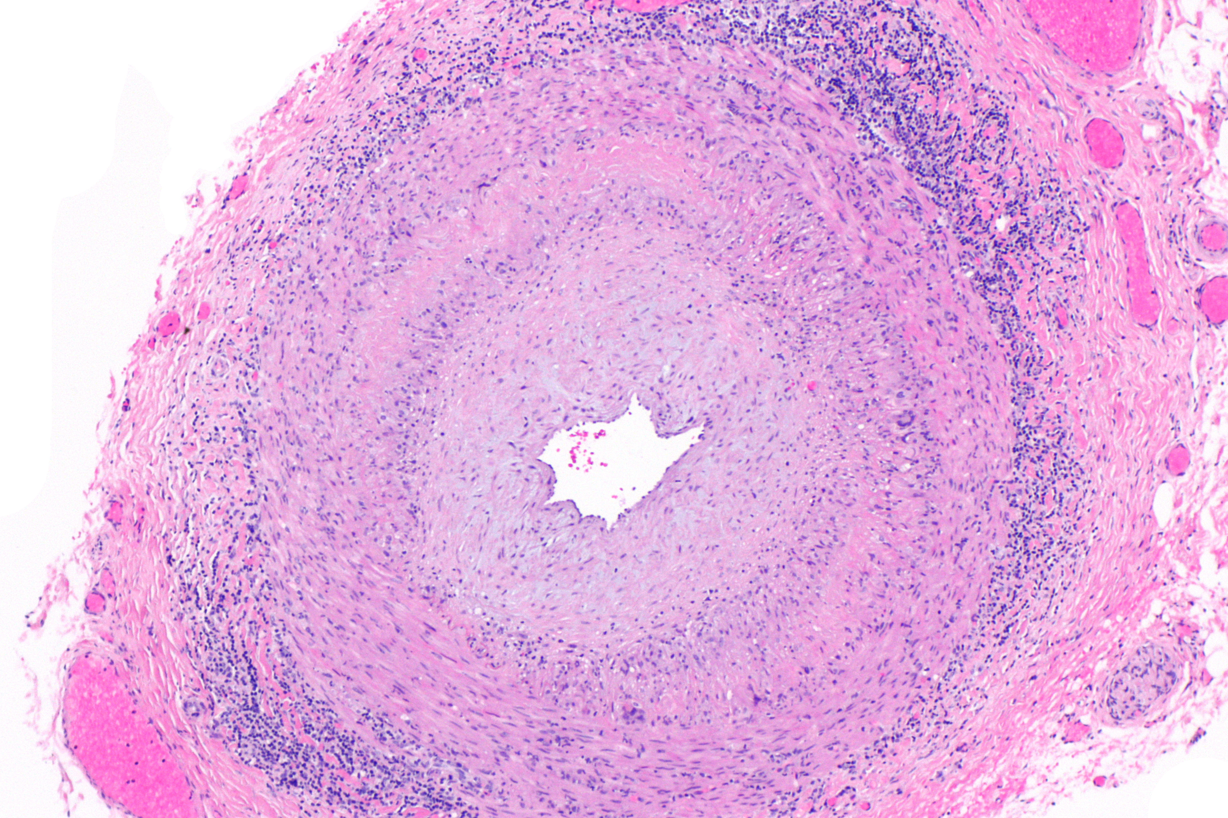 File:Giant cell arteritis -- low mag.jpg