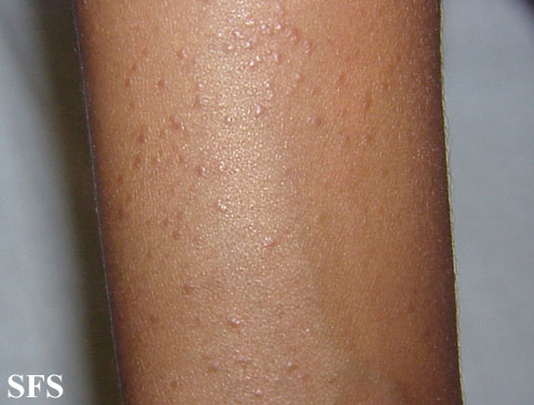Lichen planus follicularis. Adapted from Dermatology Atlas.[1]