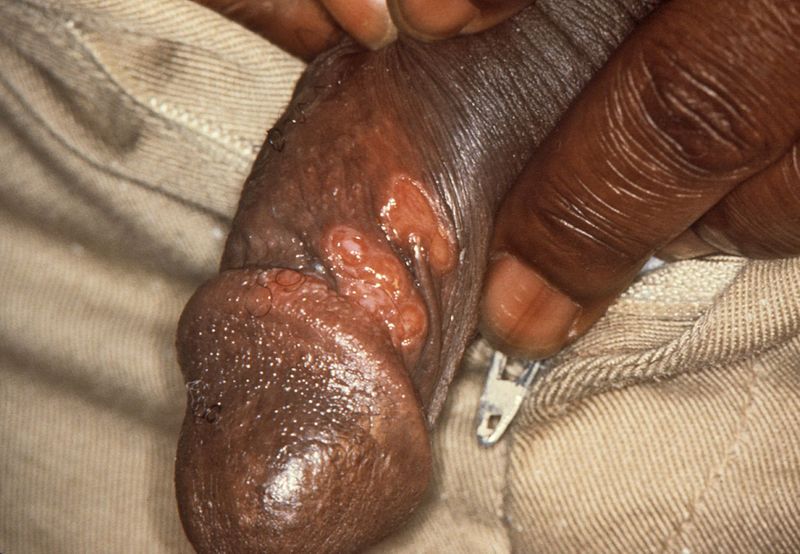 Chancres on the penile shaft due to a primary syphilitic infection