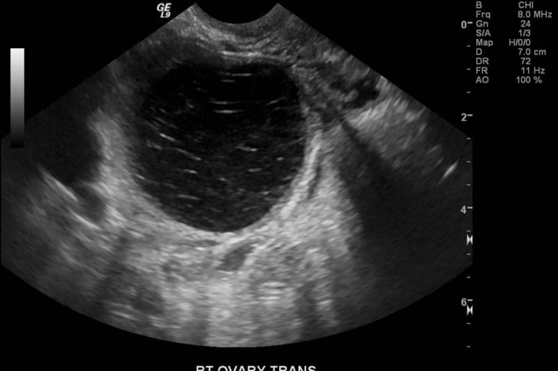File:Hemorrhagic ovarian cyst ultrasound 102.jpg