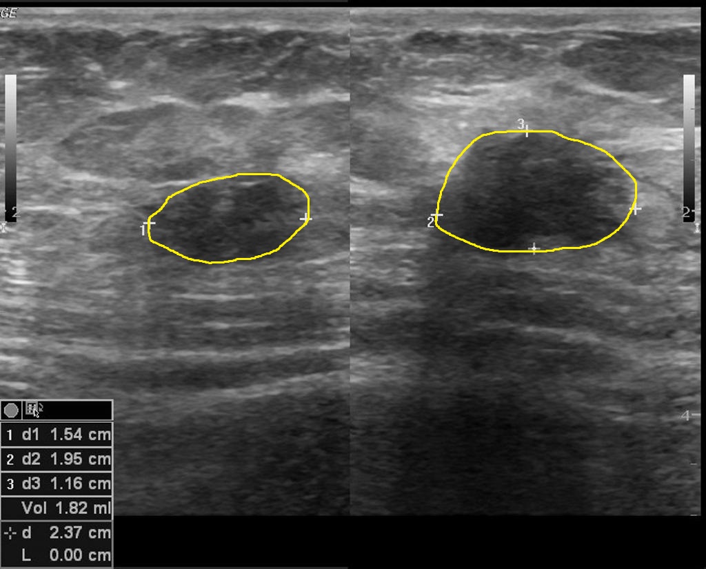 Ultrasound showing scarring of endometriosis