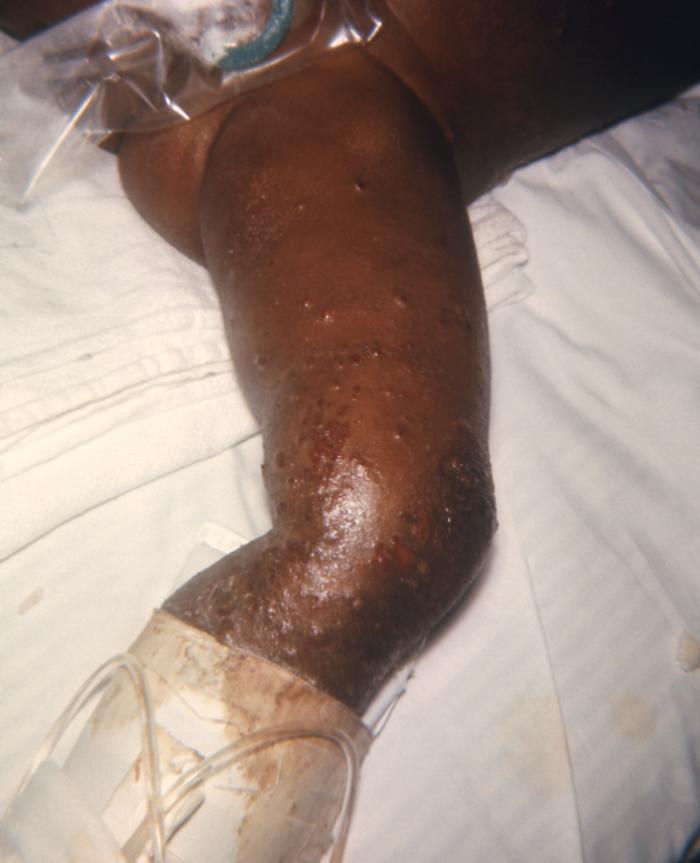 Child developed a case of eczema vaccinatum after having received a smallpox vaccination.Adapted from Public Health Image Library (PHIL), Centers for Disease Control and Prevention.[3]