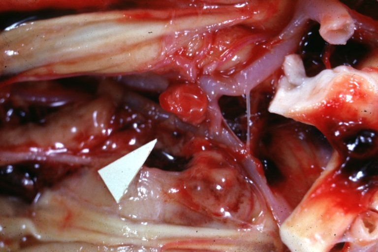 Brain: Berry Aneurysm: Gross, natural color, close-up, an excellent view of typical berry aneurysm located on anterior cerebral artery