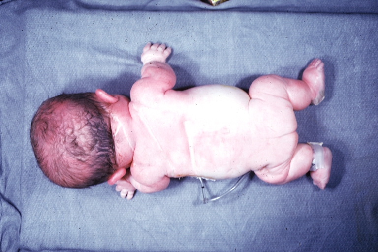 Dyschondroplasia: Gross whole body viewed from rear an infant with dyschondroplasia