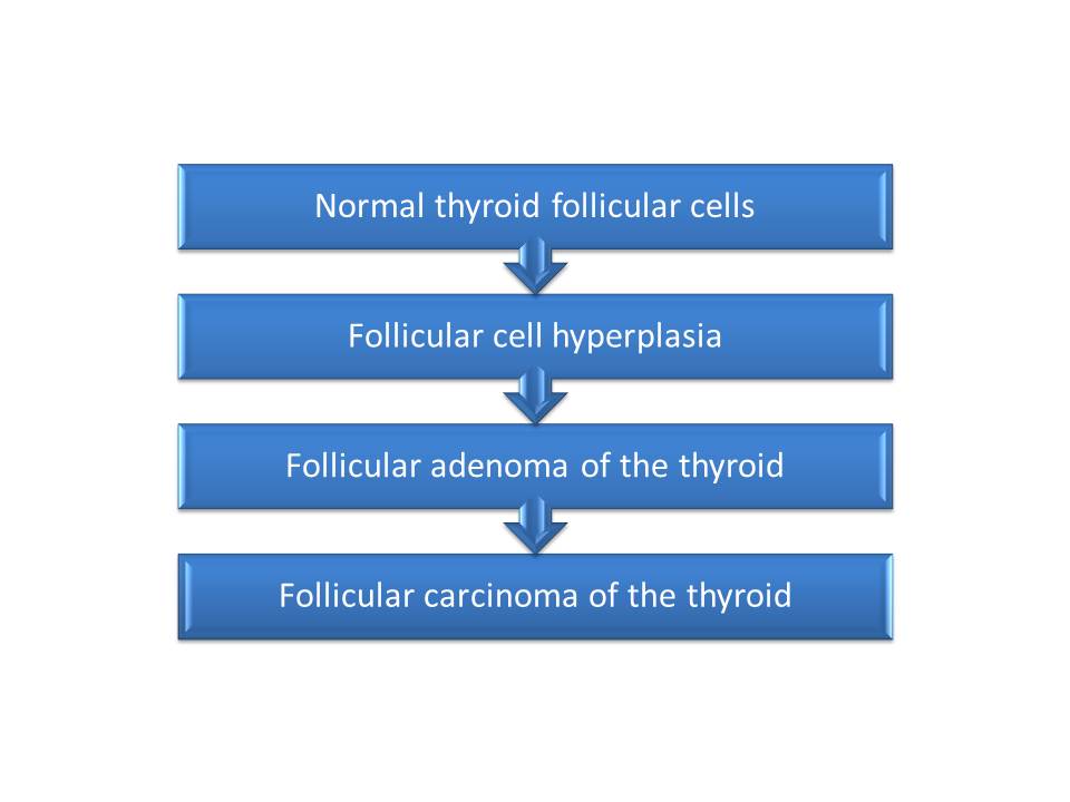 File:Follicular thyroid carcinoma pathogenesis 2.0.jpg