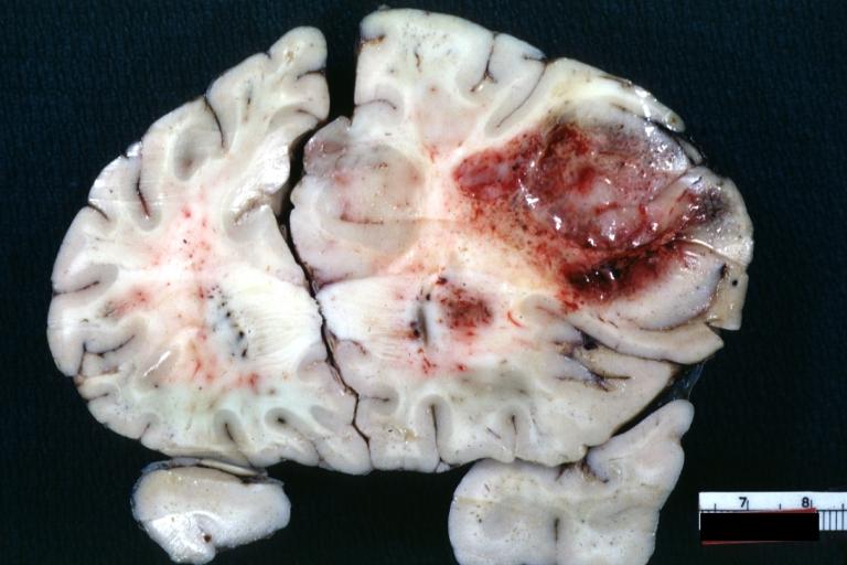 Brain: Glioblastoma Multiforme: Gross natural color large hemorrhagic lesion in right centrum semiovale