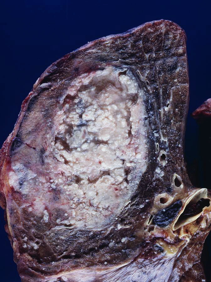 Gross pathology: Squamous lung cell cancer