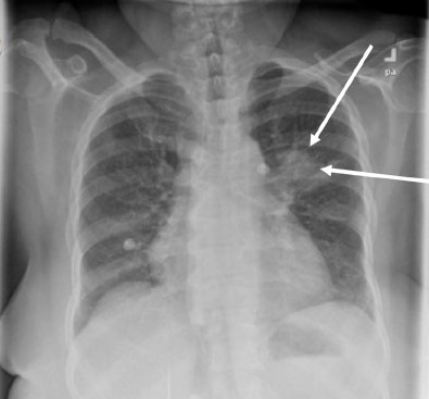 File:Pulmonary mucormycosis xray.jpg