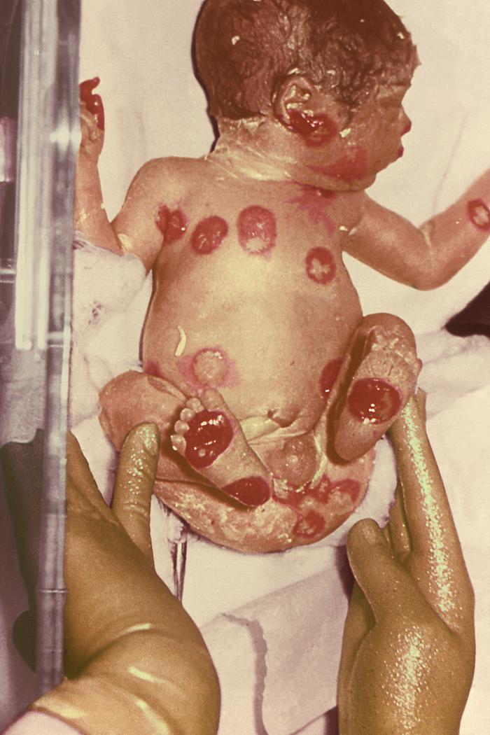 Newborn infant delivered during its 28th week of gestation, to a mother who’d received a primary smallpox vaccination during the 23rd week of her pregnancy. Upon delivery, this infant displayed typical vaccinial skin lesions, and died at 8 days of age. Vaccinia virus was isolated from the placenta. Adapted from Public Health Image Library (PHIL), Centers for Disease Control and Prevention.[14]