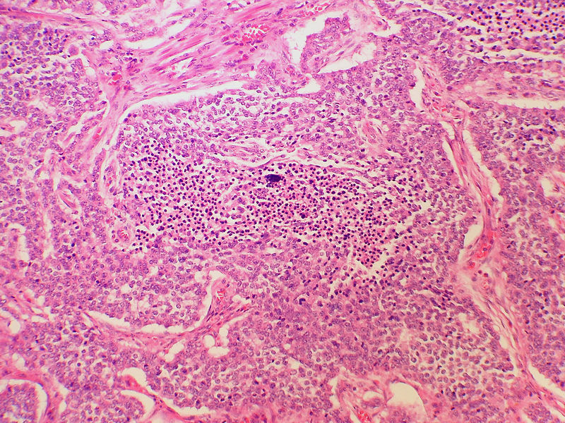 Appendiceal carcinoid with necrosis[4]