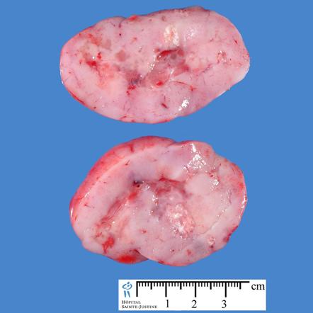 Medulloblastoma pink and well circumscribed mass[5]