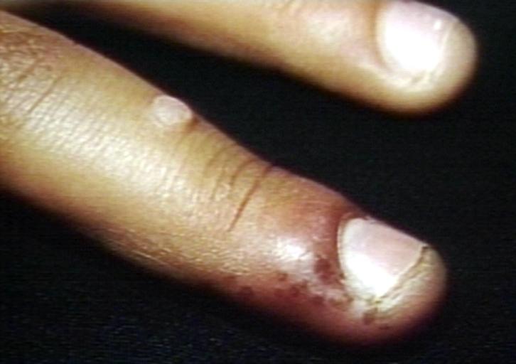 Herpes simplex caused nail disease.