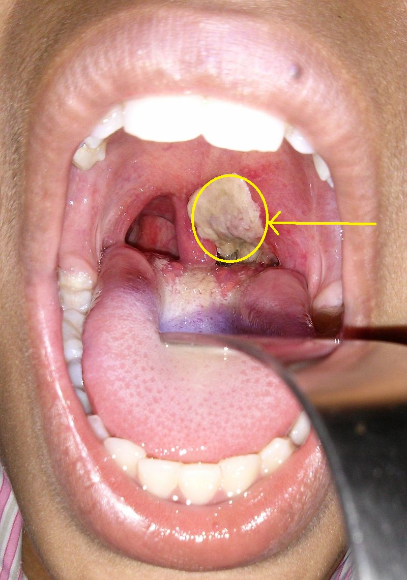 File:Diphtherial pharyngitis 1.jpg