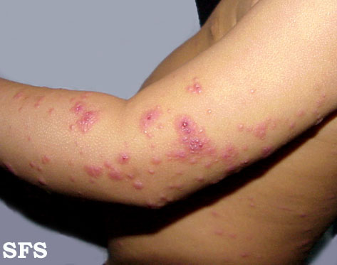 Eczema herpeticum. Adapted from Dermatology Atlas.[1]