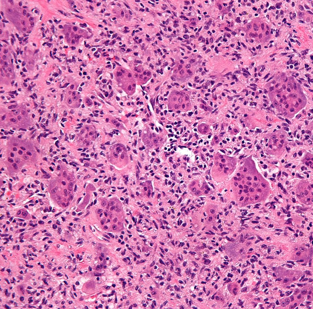 File:Giant-cell-tumour-histology.jpg
