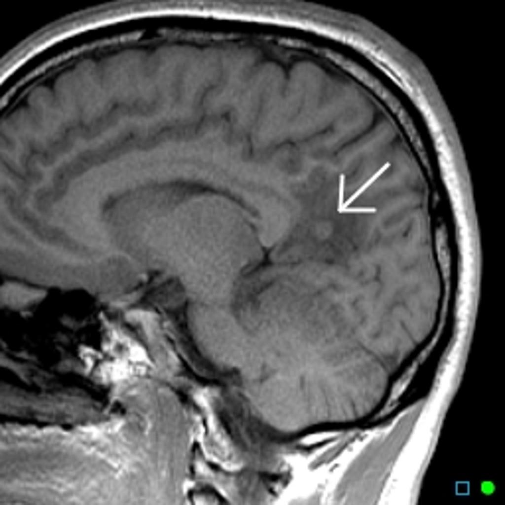 File:Neurocysticercosis-10.jpg