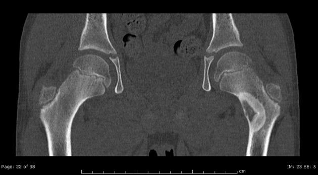 Osteoblastoma: Internal matrix mineralisation is better appreciated on CT Adapted from Radiopedia
