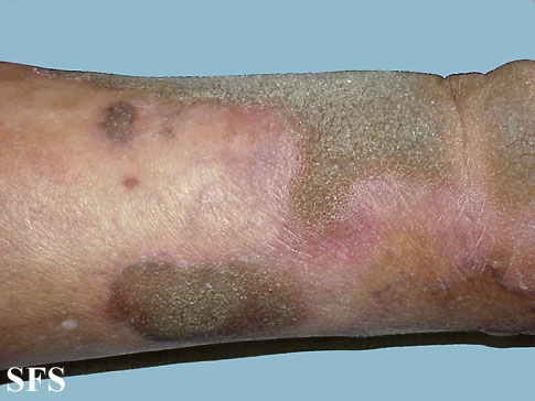 Progressive palmoplantar keratoderma. With permission from Dermatology Atlas.[1]