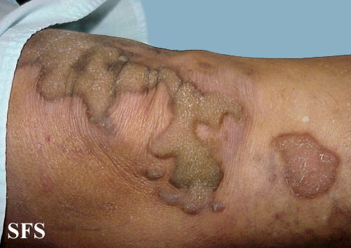 Progressive palmoplantar keratoderma. Adapted from Dermatology Atlas.[1]