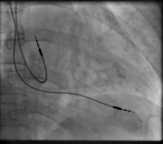 File:Fluoroscopy pacemaker leads right atrium ventricle.png