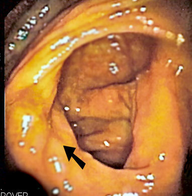 Endoscopic image of cecum with arrow pointing to ileocecal valve in foreground.