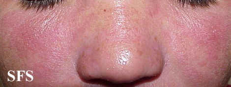 File:Nail polish dermatitis09.jpg
