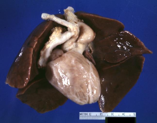 Patent Ductus Arteriosus with Aneurysmal Dilation: Gross fixed tissue external photo of heart shows the lesion