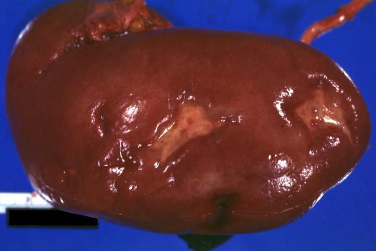 Kidney: Infarct Remote: Gross external view with capsule removed two old and very typical infarct scars 27 year old person with dilated cardiomyopathy
