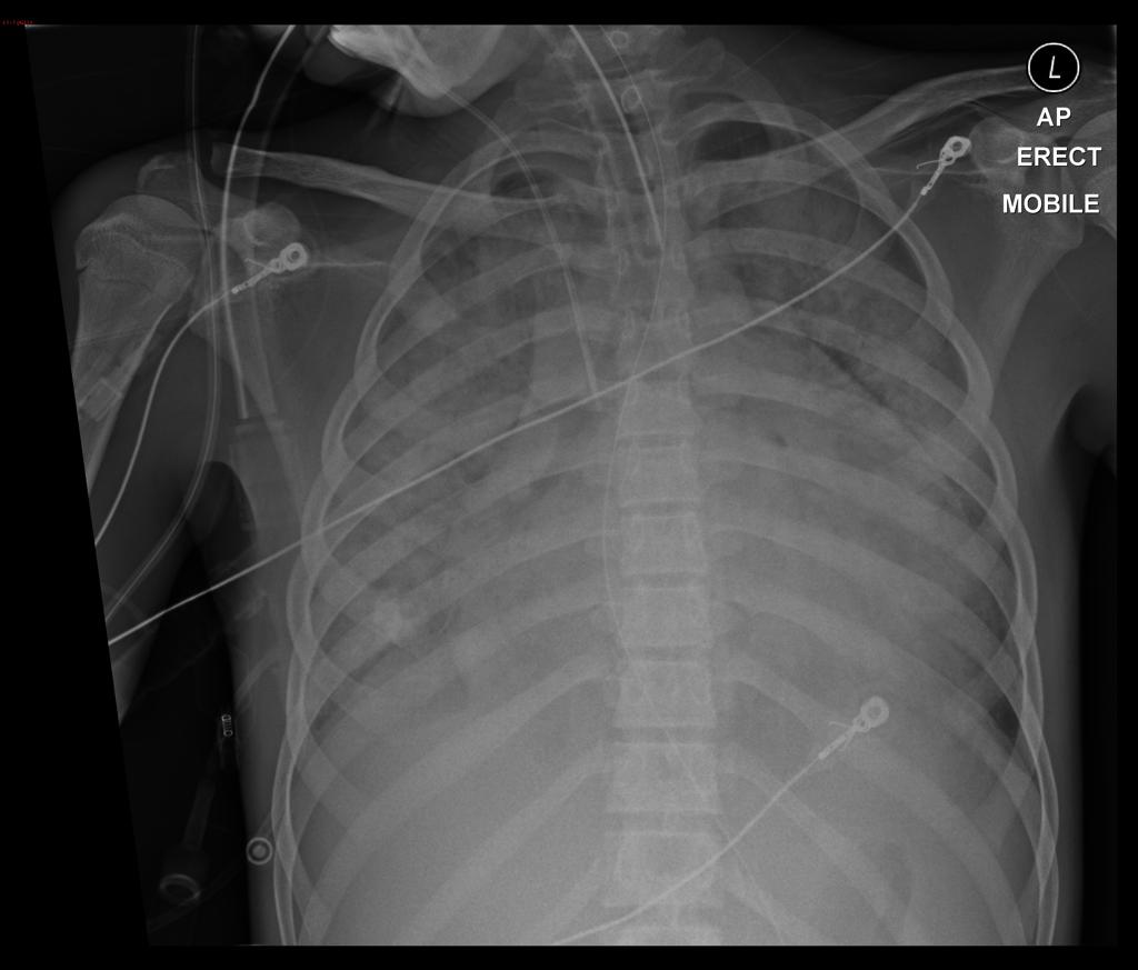 Patient was intubated and ventilated. A diagnosis of rheumatic heart disease was made. Cardiomegaly is present.<ref name=XRAY> Image courtesy of Dr. David Preston Radiopaedia (original file [2]). Creative Commons BY-SA-NC