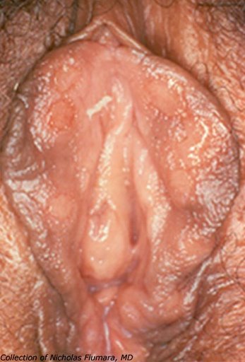 Condyoma lata (syphilis secondary)