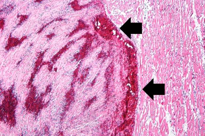 This is a low-power photomicrograph of a mural thrombus (1) adherent to the endocardial surface (arrows).