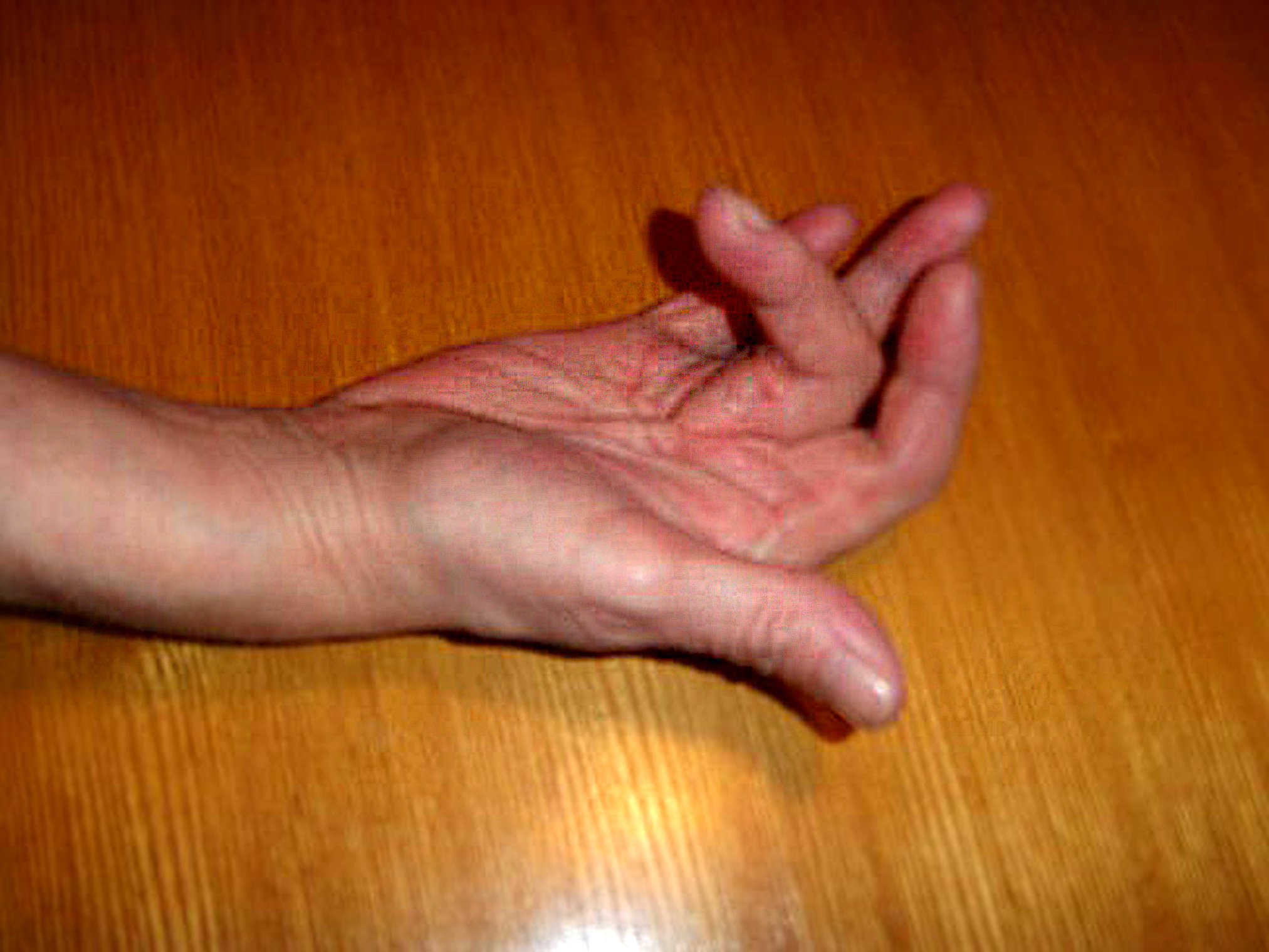 Dupuytren's contracture. [commons.wikimedia.org/wiki/File:Dupuytren's_contracture.jpg/ Adapted from Wikimedia Commons.][4]