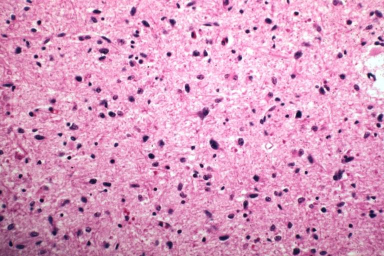 CNS: Glioblastoma multiforme; Brain: Glioblastoma multiforme. Grade I-Ii: Micro med mag with H&E, tumor well shown