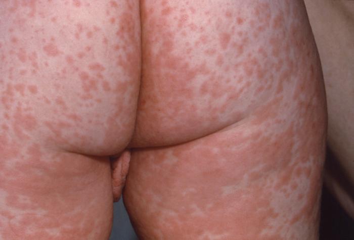 File:Measles 3.jpg