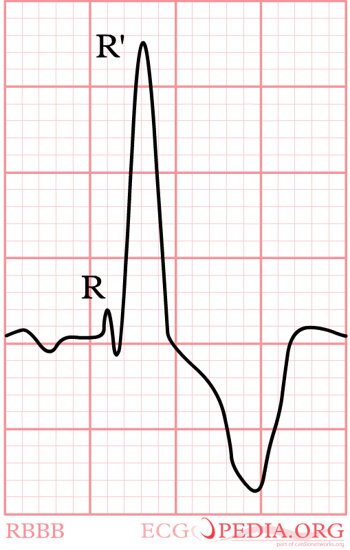 The main characteristics of Right Bundle Branch Block in V1