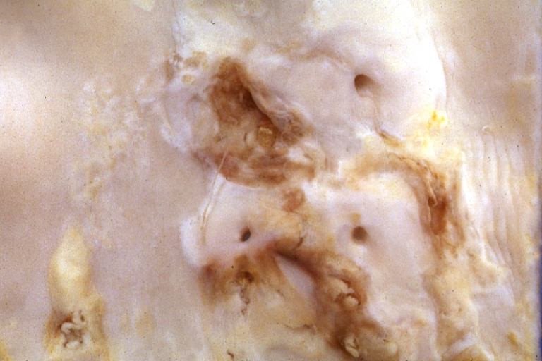 Atherosclerosis: Gross, close-up view of aorta. A plaque with ulceration and thrombosis
