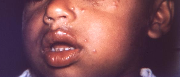 Child’s face revealing the distribution of a mild maculopapular rash due to smallpox. From Public Health Image Library (PHIL). [5]