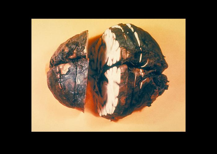 "Gross pathology of fixed, cut brain showing hemorrhagic meningitis due to inhalation anthrax.”Adapted from Public Health Image Library (PHIL), Centers for Disease Control and Prevention.[20]